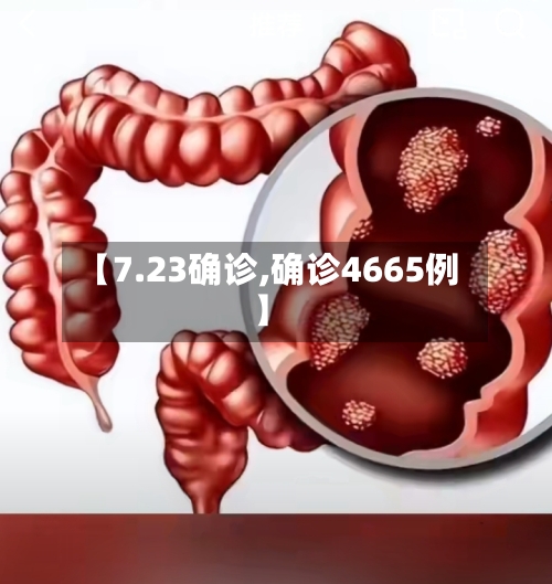 【7.23确诊,确诊4665例】