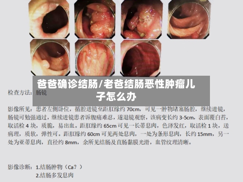 爸爸确诊结肠/老爸结肠恶性肿瘤儿子怎么办