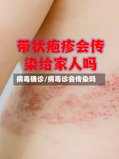 病毒确诊/病毒诊会传染吗-第2张图片