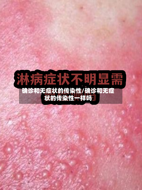 确诊和无症状的传染性/确诊和无症状的传染性一样吗-第2张图片