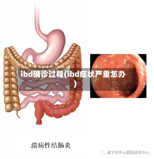 ibd确诊过程(ibd症状严重怎办)-第3张图片