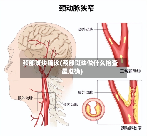 颈部斑块确诊(颈部斑块做什么检查最准确)-第3张图片
