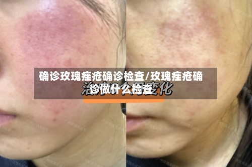 确诊玫瑰痤疮确诊检查/玫瑰痤疮确诊做什么检查