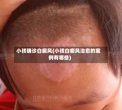 小孩确诊白癜风(小孩白癜风治愈的案例有哪些)-第3张图片