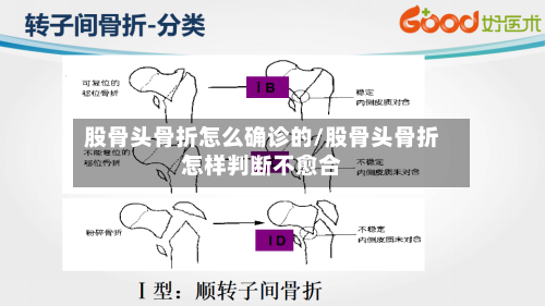 股骨头骨折怎么确诊的/股骨头骨折怎样判断不愈合-第2张图片