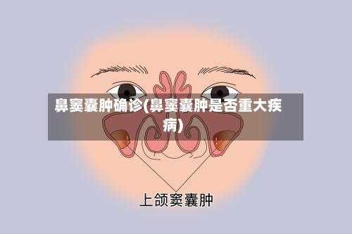 鼻窦囊肿确诊(鼻窦囊肿是否重大疾病)