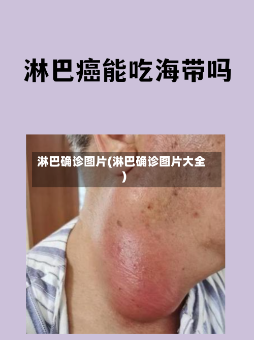 淋巴确诊图片(淋巴确诊图片大全)