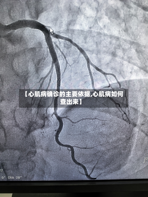 【心肌病确诊的主要依据,心肌病如何查出来】-第3张图片