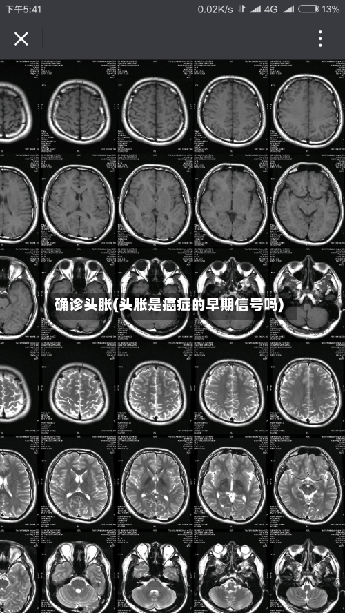 确诊头胀(头胀是癌症的早期信号吗)-第2张图片