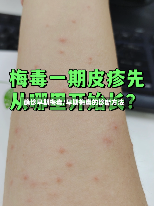 确诊早期梅毒/早期梅毒的诊断方法-第3张图片