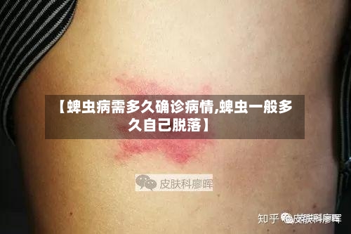 【蜱虫病需多久确诊病情,蜱虫一般多久自己脱落】-第3张图片