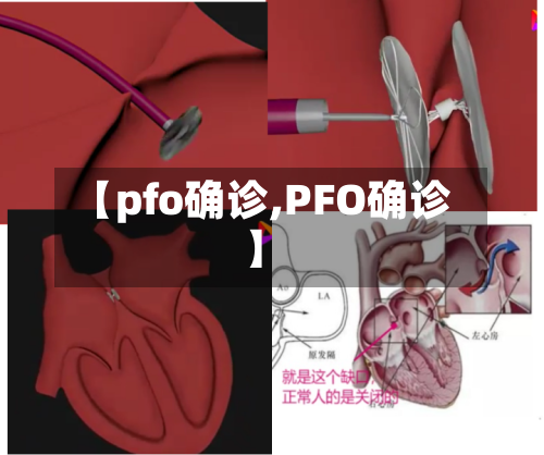 【pfo确诊,PFO确诊】-第2张图片