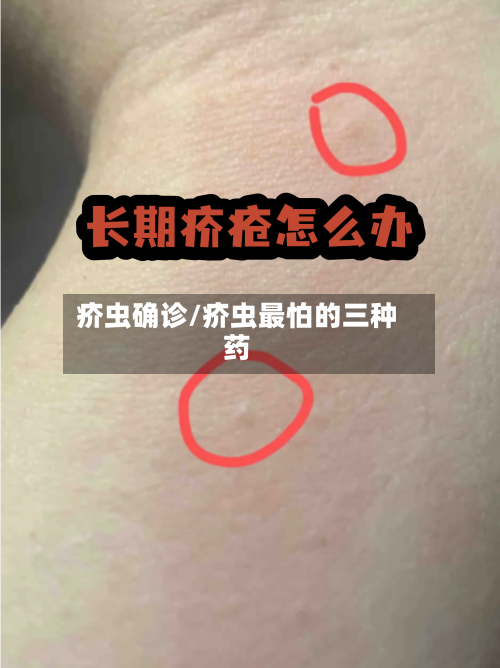 疥虫确诊/疥虫最怕的三种药
