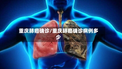重庆肺癌确诊/重庆肺癌确诊病例多少