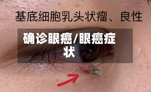 确诊眼癌/眼癌症状
