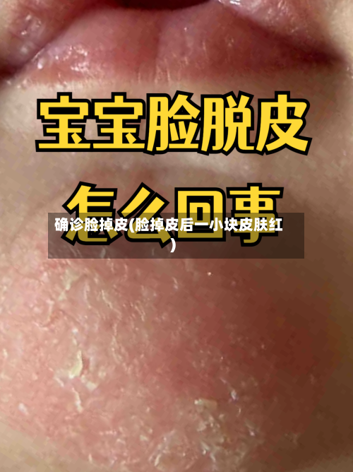 确诊脸掉皮(脸掉皮后一小块皮肤红)-第2张图片