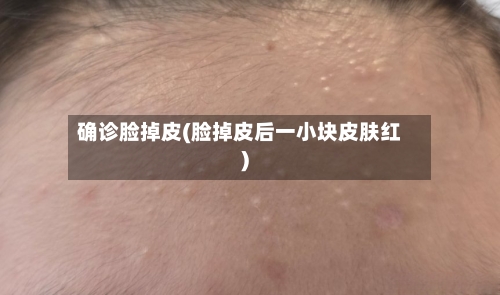 确诊脸掉皮(脸掉皮后一小块皮肤红)