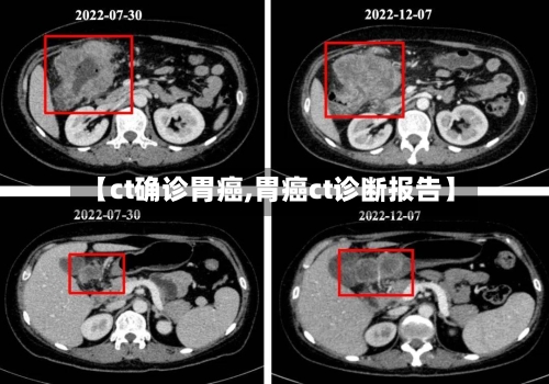 【ct确诊胃癌,胃癌ct诊断报告】-第2张图片