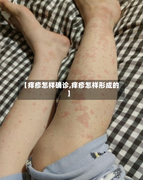 【痒疹怎样确诊,痒疹怎样形成的】