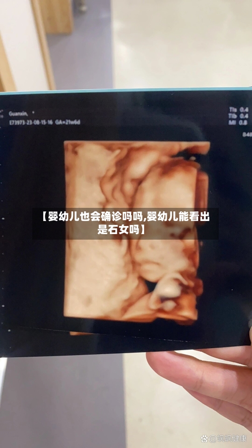 【婴幼儿也会确诊吗吗,婴幼儿能看出是石女吗】-第3张图片