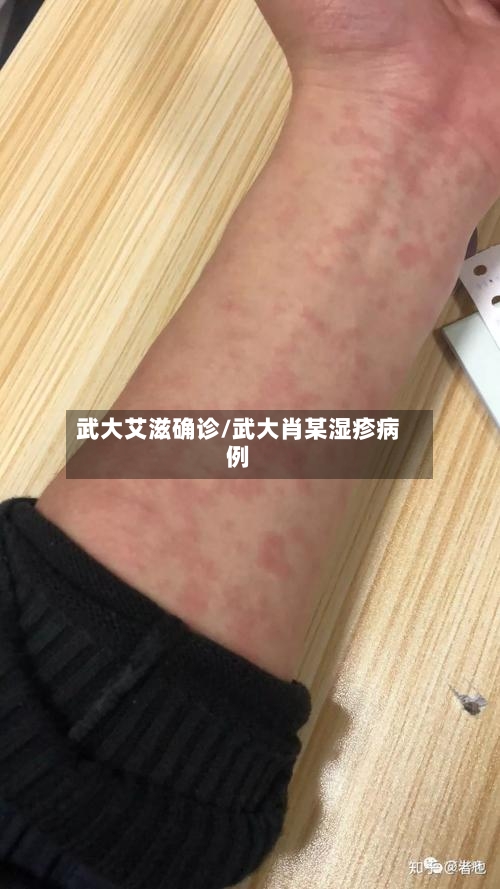 武大艾滋确诊/武大肖某湿疹病例-第2张图片