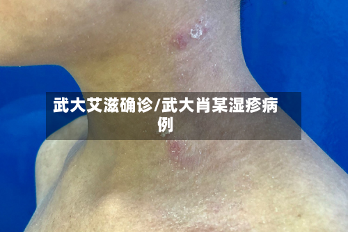 武大艾滋确诊/武大肖某湿疹病例