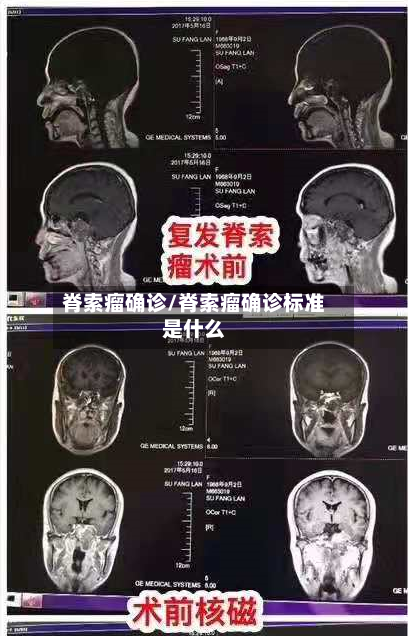 脊索瘤确诊/脊索瘤确诊标准是什么