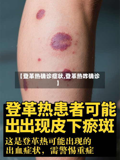 【登革热确诊症状,登革热咋确诊】-第2张图片