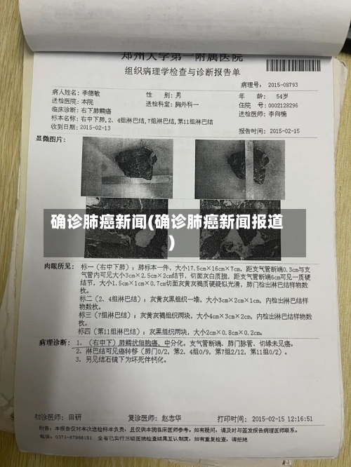 确诊肺癌新闻(确诊肺癌新闻报道)